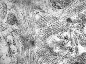 M,42y. | mild endocardial fibrosis - left ventricle (crossing of myofibrils,perhaps artifactual)